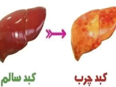 کبدچرب